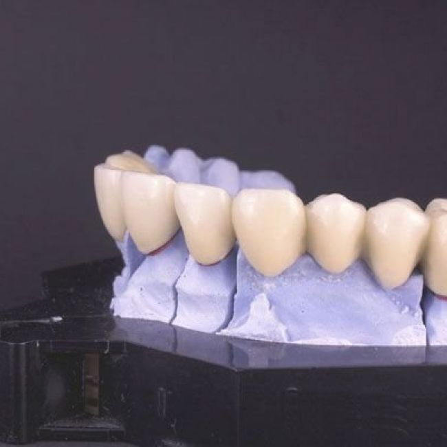 implants Terrassa dentals