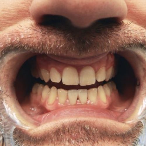 fracturas dentales post