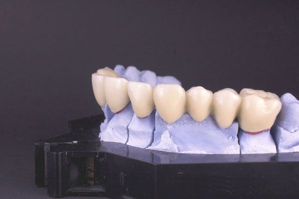 implants Terrassa dentals